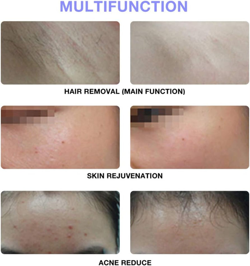 Smart IPL Hair Removal Device – 900K Flashes