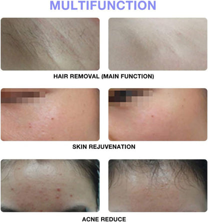 Smart IPL Hair Removal Device – 900K Flashes